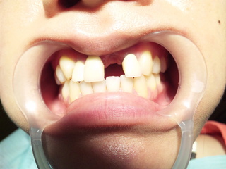 smiledenture1.JPG